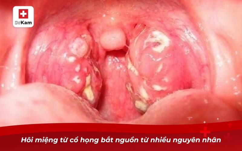 Hôi miệng từ cổ họng bắt nguồn từ nhiều nguyên nhân