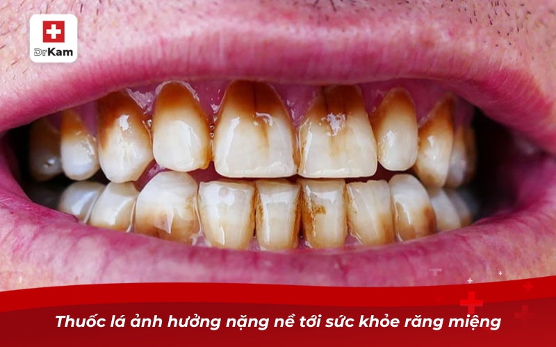TOP 5 Nước súc miệng hỗ trợ cai thuốc hiệu quả 7 Thuốc lá ảnh hưởng nặng nề tới sức khỏe răng miệng