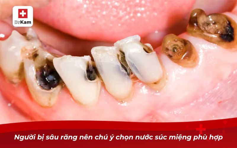 Người bị sâu răng nên chú ý chọn nước súc miệng trị sâu răng phù hợp