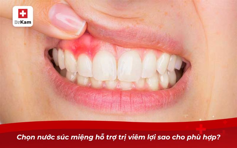 Top 10 loại nước súc miệng hỗ trợ trị viêm lợi triệt để 9 Chọn nước súc miệng hỗ trợ trị viêm lợi sao cho phù hợp?