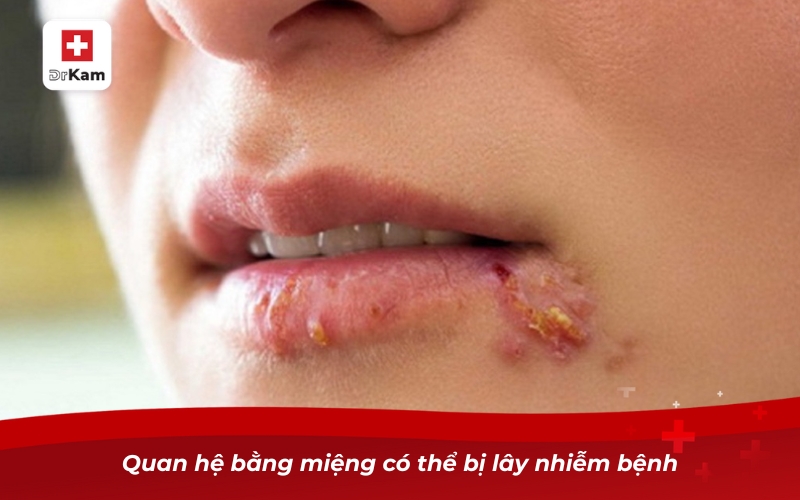 Quan hệ bằng miệng có thể bị lây nhiễm bệnh