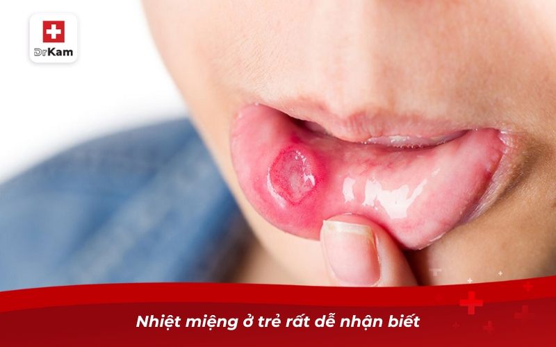 Xịt nhiệt miệng cho bé - Giải pháp hiệu quả và an toàn 7 Nhiệt miệng ở trẻ rất dễ nhận biết