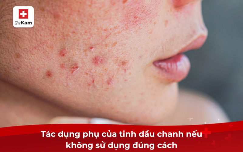 Tinh dầu chanh và lợi ích vượt trội cho sức khỏe 9 Tác dụng phụ của tinh dầu chanh nếu không sử dụng đúng cách