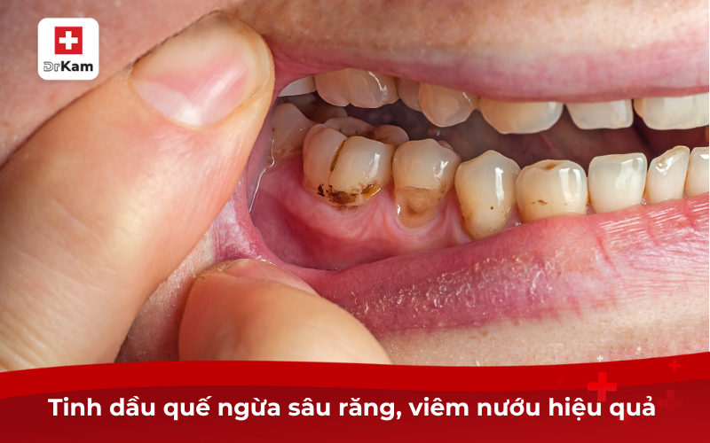 Tìm hiểu về tinh dầu quế và tác dụng đối với sức khỏe 7 Tinh dầu quế ngừa sâu răng, viêm nướu hiệu quả