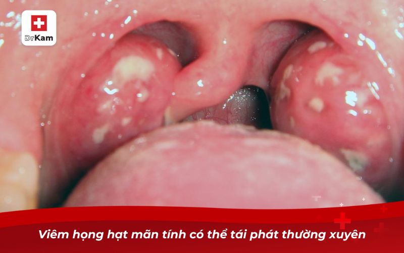 Những bài thuốc nam chữa viêm họng hạt mãn tính 10 Viêm họng hạt mãn tính có thể tái phát thường xuyên