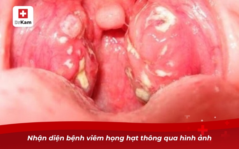Bệnh viêm họng hạt – Làm sao nhận biết và điều trị dứt điểm? 7 Nhận diện bệnh viêm họng hạt thông qua hình ảnh