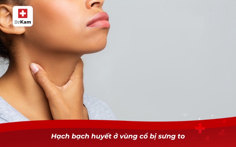 Biểu hiện viêm họng hạt - Hướng dẫn nhận biết và điều trị 13 Hạch bạch huyết ở vùng cổ bị sưng to