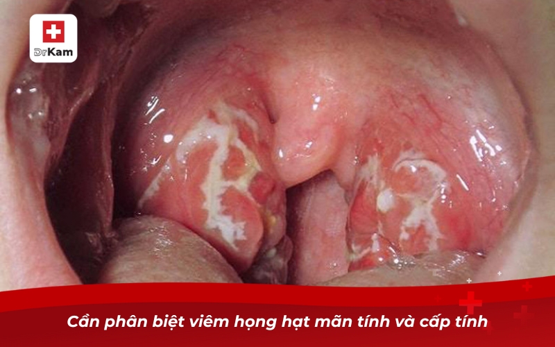 Biểu hiện viêm họng hạt - Hướng dẫn nhận biết và điều trị 16 Cần phân biệt viêm họng hạt mãn tính và cấp tính