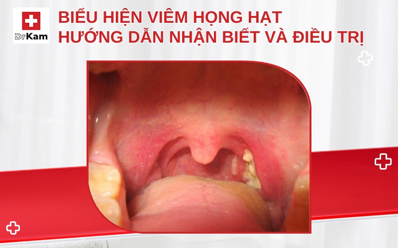 bieu hien viem hong hat thumbnail