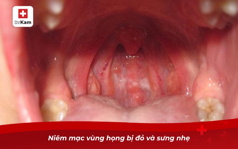 Các Dấu Hiệu Viêm Họng Bạn Nên Biết 10 Niêm mạc vùng họng bị đỏ và sưng nhẹ