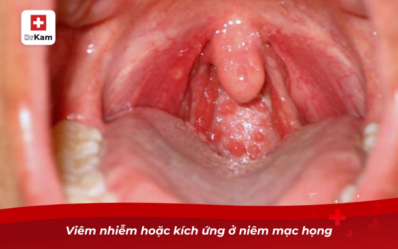 Các loại viêm họng - Phân loại triệu chứng và điều trị 13 Viêm nhiễm hoặc kích ứng ở niêm mạc họng