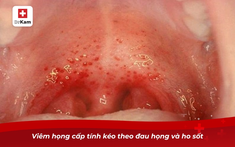 Các loại viêm họng - Phân loại triệu chứng và điều trị 14 Viêm họng cấp tính kéo theo đau họng và ho sốt
