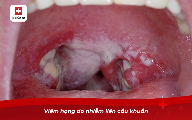 Các loại viêm họng - Phân loại triệu chứng và điều trị 15 Viêm họng do nhiễm liên cầu khuẩn