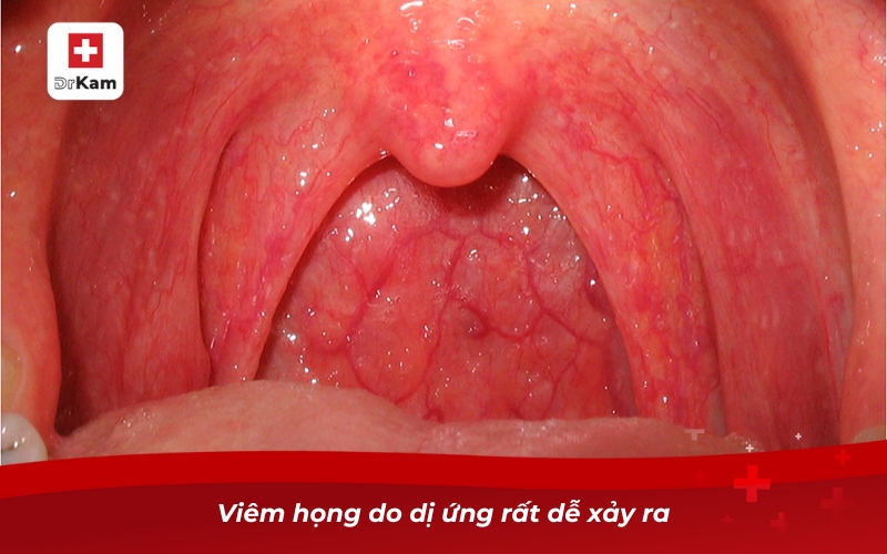 Các loại viêm họng - Phân loại triệu chứng và điều trị 16 Viêm họng do dị ứng rất dễ xảy ra