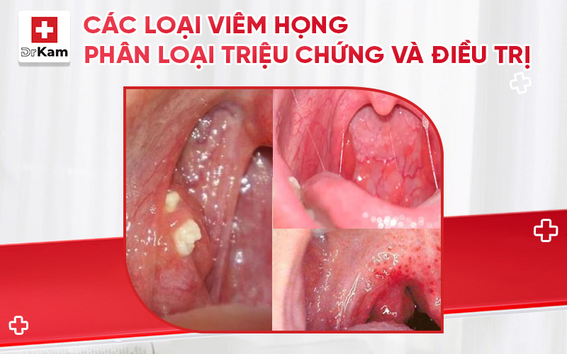 cac loai viem hong thumbnail
