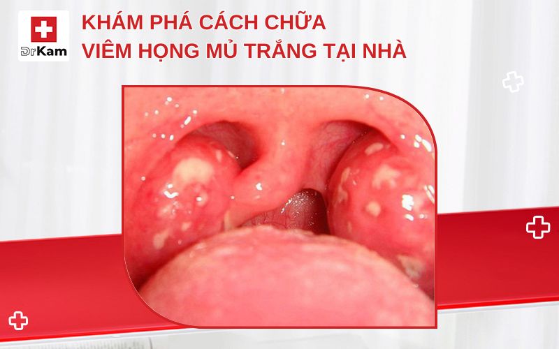 cach chua viem hong mu trang tai nha thumbnail