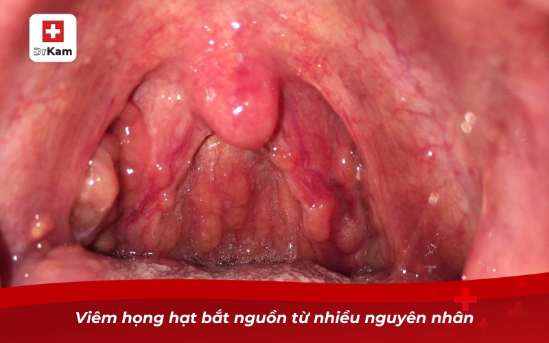 Cách điều trị viêm họng hạt hiệu quả nhất hiện nay 8 Viêm họng hạt bắt nguồn từ nhiều nguyên nhân