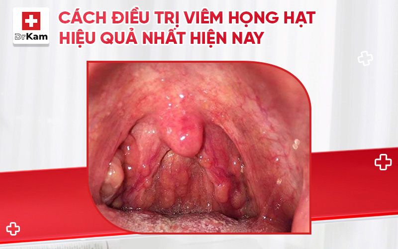 cach dieu tri viem hong hat thumbnail