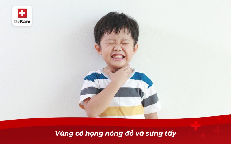Cách nhận biết bé bị viêm họng chuẩn xác nhất 14 Vùng cổ họng nóng đỏ và sưng tấy