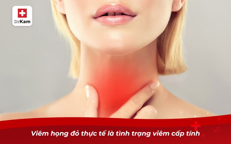 Viêm họng đỏ thực tế là tình trạng viêm cấp tính