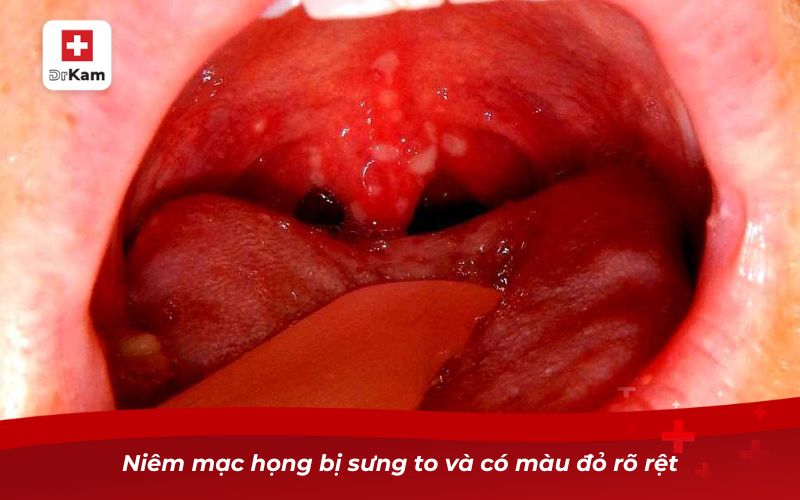 Niêm mạc họng bị sưng to và có màu đỏ rõ rệt