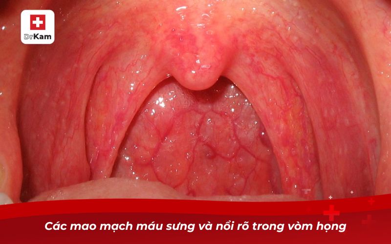 Các mao mạch máu sưng và nổi rõ trong vòm họng