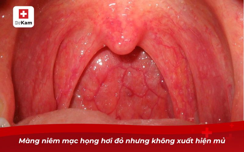 Hình ảnh viêm họng hạt ở trẻ em và cách nhận biết bé bị viêm họng 11 Màng niêm mạc họng hơi đỏ nhưng không xuất hiện mủ