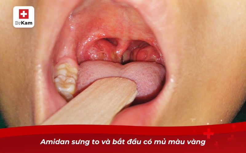 Hình ảnh viêm họng hạt ở trẻ em và cách nhận biết bé bị viêm họng 12 Amidan sưng to và bắt đầu có mủ màu vàng