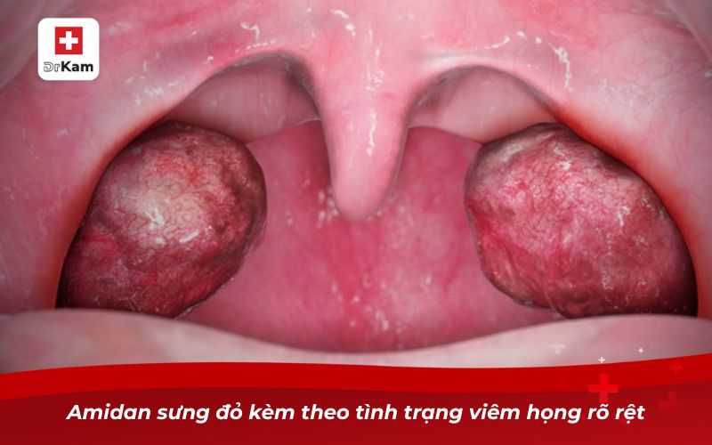 Hình ảnh viêm họng hạt ở trẻ em và cách nhận biết bé bị viêm họng 13 Amidan sưng đỏ kèm theo tình trạng viêm họng rõ rệt