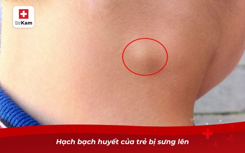 Hình ảnh viêm họng hạt ở trẻ em và cách nhận biết bé bị viêm họng 15 Hạch bạch huyết của trẻ bị sưng lên