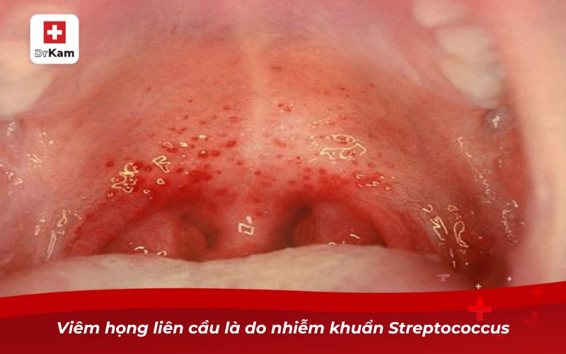 Hình ảnh viêm họng liên cầu khuẩn và những điều cần biết 6 Viêm họng liên cầu là do nhiễm khuẩn Streptococcus