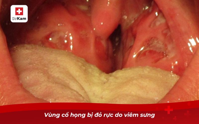 Hình ảnh viêm họng liên cầu khuẩn và những điều cần biết 7 Vùng cổ họng bị đỏ rực do viêm sưng