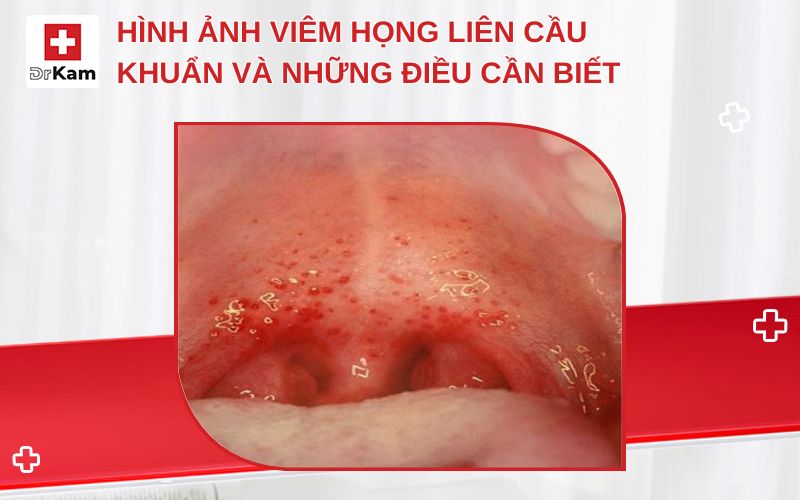 hinh anh viem hong lien cau khuan thumbnail