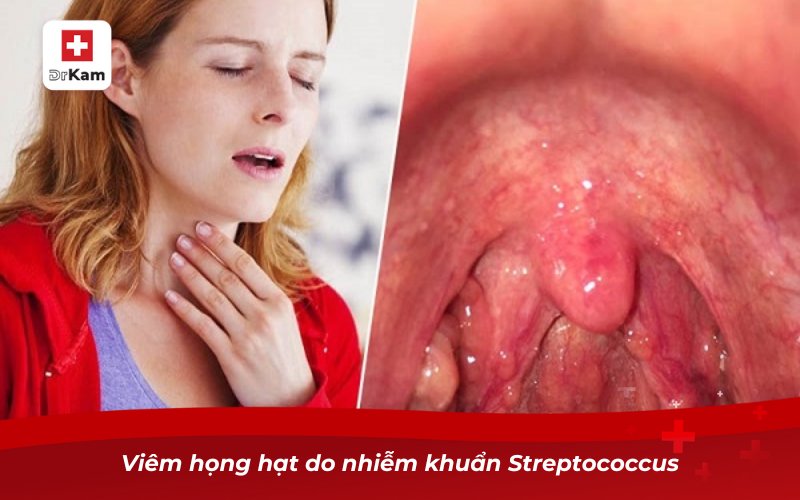 Top 10 Nguyên nhân viêm họng hạt phổ biến 8 Viêm họng hạt do nhiễm khuẩn Streptococcus