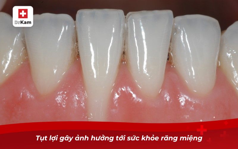 Nước súc miệng chữa tụt lợi giúp phục hồi nướu hiệu quả 7 Tụt lợi gây ảnh hưởng tới sức khỏe răng miệng