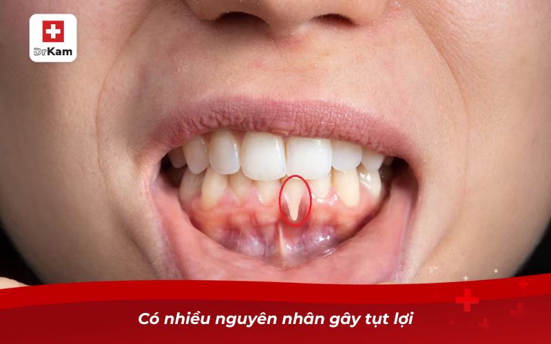 Nước súc miệng chữa tụt lợi giúp phục hồi nướu hiệu quả 8 Có nhiều nguyên nhân gây tụt lợi