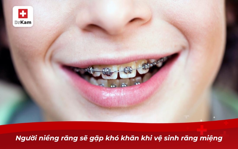 Người niềng răng sẽ gặp khó khăn khi vệ sinh răng miệng