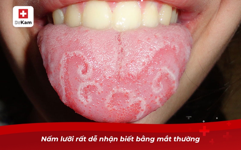 Những điều cần biết về nước súc miệng hỗ trợ trị nấm lưỡi 8 Nấm lưỡi rất dễ nhận biết bằng mắt thường