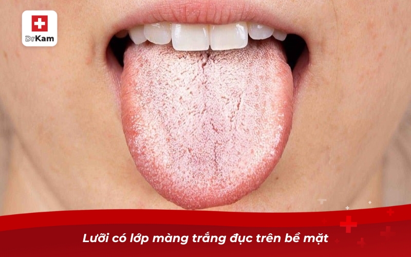 Những điều cần biết về nước súc miệng hỗ trợ trị nấm lưỡi 9 Lưỡi có lớp màng trắng đục trên bề mặt