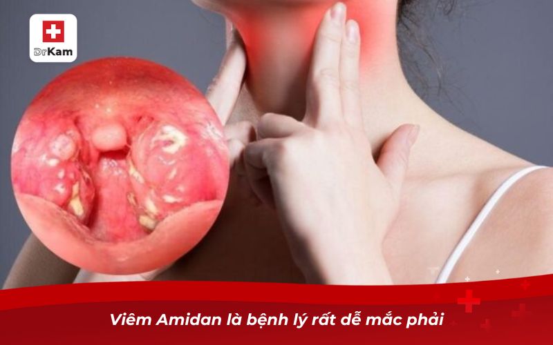 Nước súc miệng hỗ trợ trị viêm amidan giảm đau họng tức thì 7 Viêm Amidan là bệnh lý rất dễ mắc phải