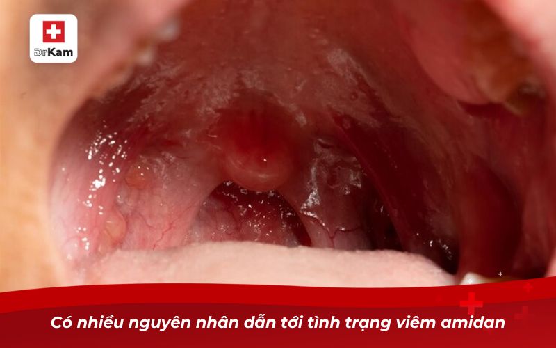 Nước súc miệng hỗ trợ trị viêm amidan giảm đau họng tức thì 8 Có nhiều nguyên nhân dẫn tới tình trạng viêm amidan