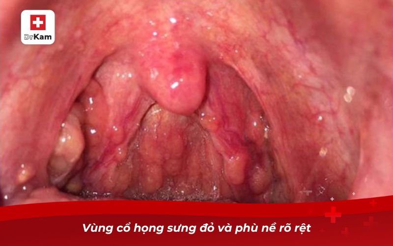 Triệu chứng viêm họng mãn tính và những điều cần biết 8 Vùng cổ họng sưng đỏ và phù nề rõ rệt