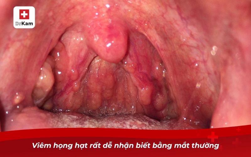 Viêm họng hạt bao lâu hết và phương pháp điều trị hiệu quả 9 Viêm họng hạt rất dễ nhận biết bằng mắt thường