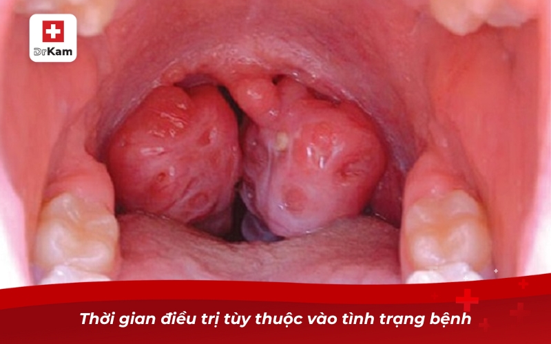 Viêm họng hạt bao lâu hết và phương pháp điều trị hiệu quả 10 Thời gian điều trị tùy thuộc vào tình trạng bệnh