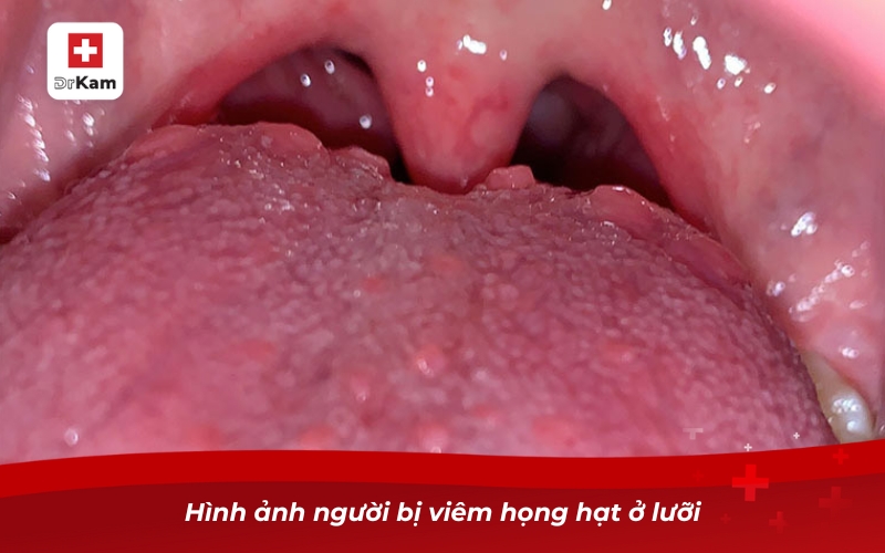Viêm họng hạt bao lâu hết và phương pháp điều trị hiệu quả 11 Hình ảnh người bị viêm họng hạt ở lưỡi