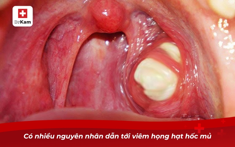 Viêm họng hạt hốc mủ - Cách nhận diện và điều trị hiệu quả 7 Có nhiều nguyên nhân dẫn tới viêm họng hạt hốc mủ