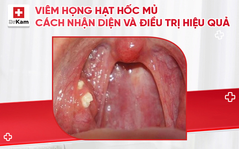 viem hong hat hoc mu thumbnail