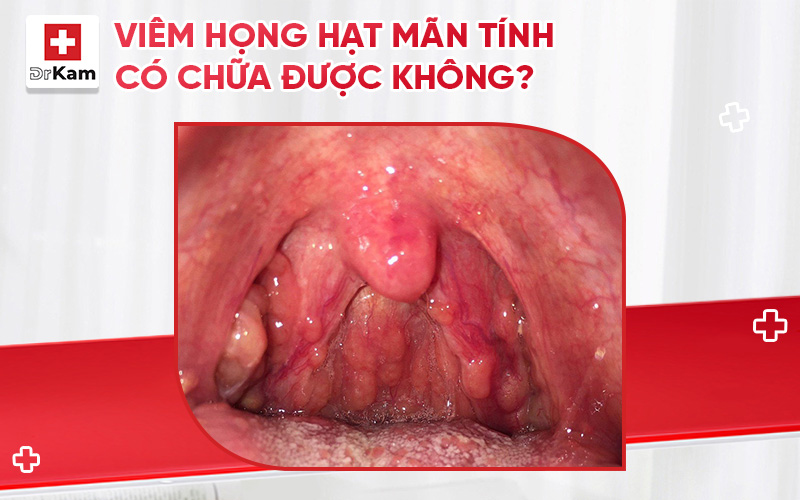viem hong hat man tinh co chua duoc khong thumbnail