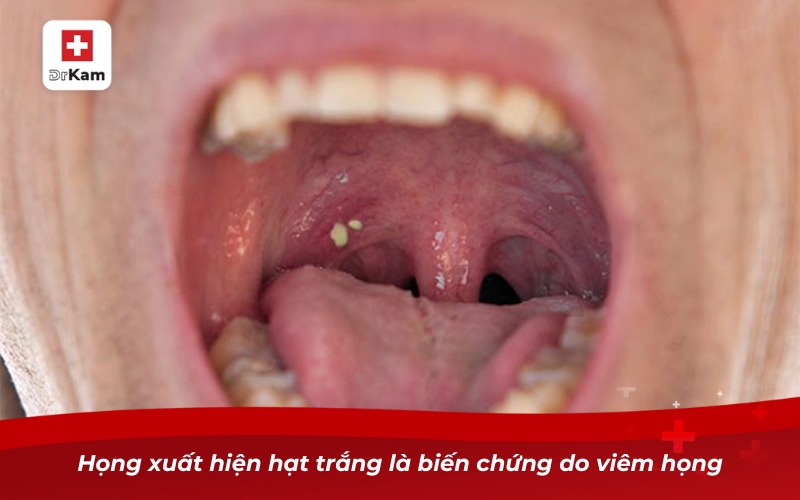 Nhận diện viêm họng hạt trắng và biện pháp điều trị 8 Họng xuất hiện hạt trắng là biến chứng do viêm họng
