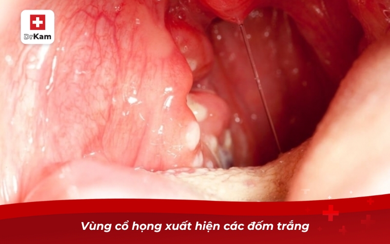Nhận diện viêm họng hạt trắng và biện pháp điều trị 11 Vùng cổ họng xuất hiện các đốm trắng